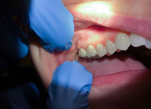 Best Emergency Dentist for Knocked-Out Tooth in New Knoxville, OH